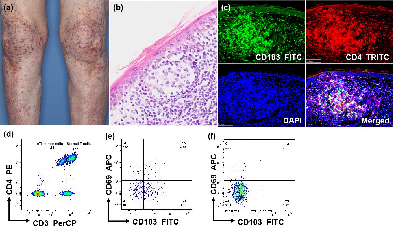 フローサイトメトリーによる皮膚リンパ腫の表面形質解析2