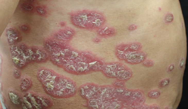 皮膚免疫と細菌叢の制御機構と炎症疾患への関わり